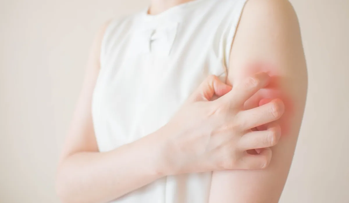 ผื่นกุหลาบ