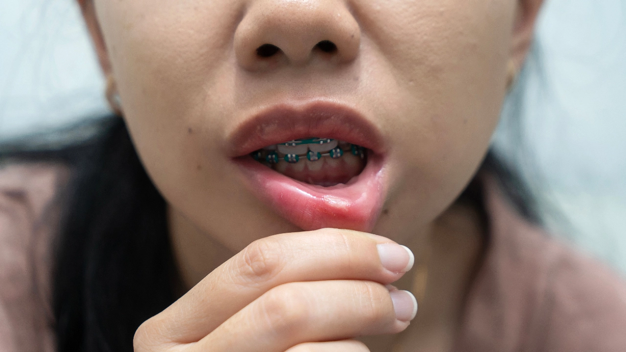 ร้อนในห้ามกินอะไร